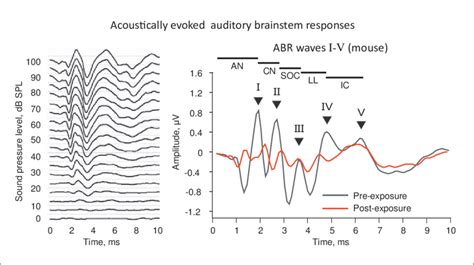 abr results interpretation|auditory brainstem response test.
